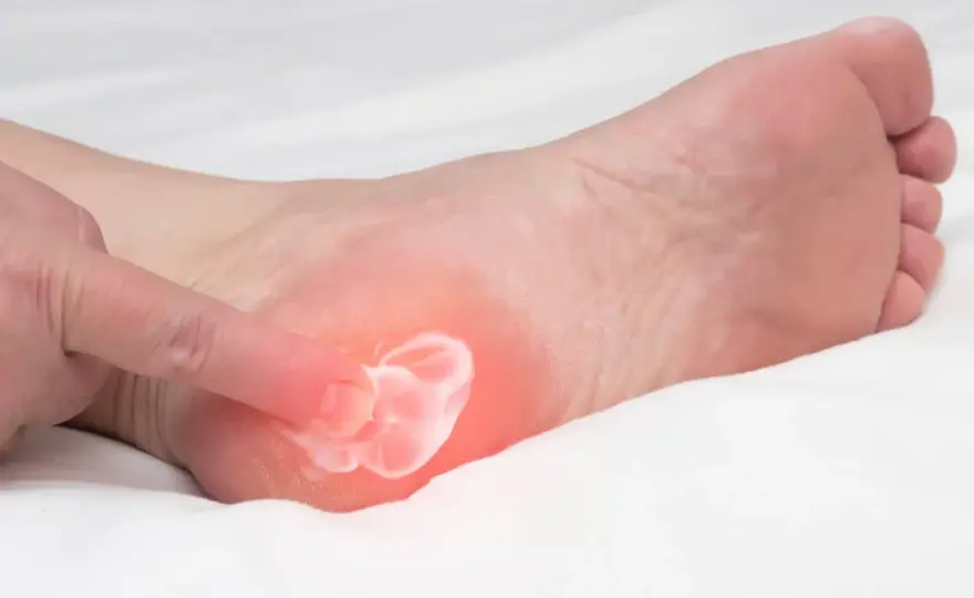 Aponévrosite plantaire, comment masser sans aggraver la douleur ?