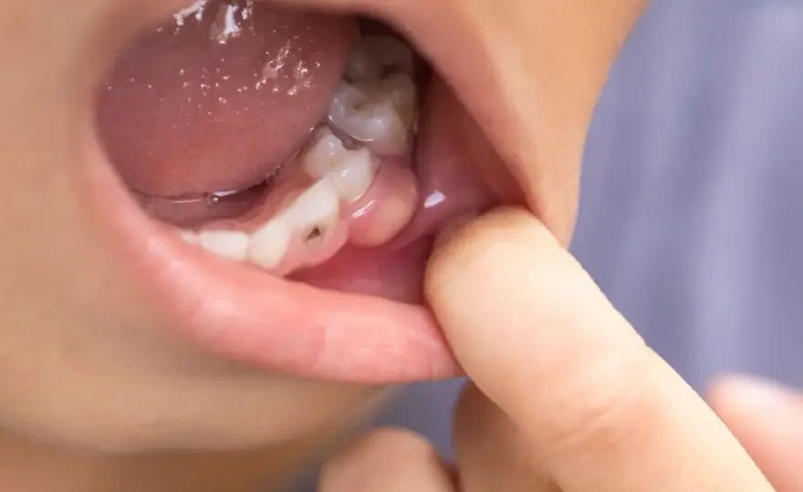 Pulpotomía dental - qué es, cuándo se indica y cómo se hace