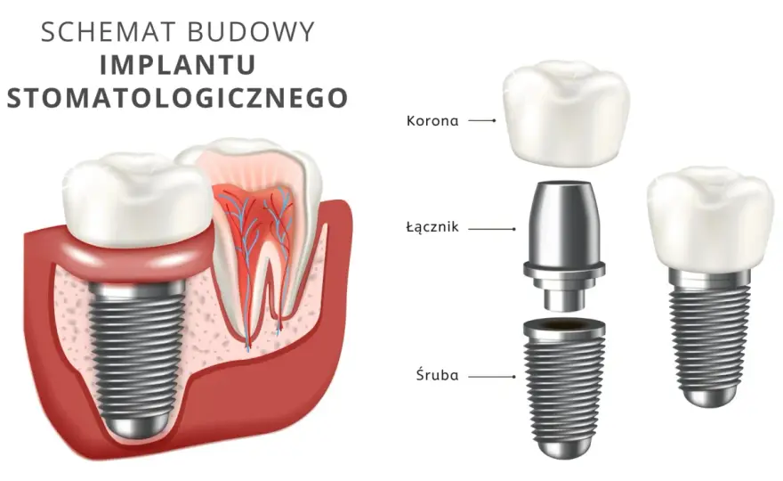 Implant szóstki - Ile naprawdę kosztuje? Nie tylko wszczep!