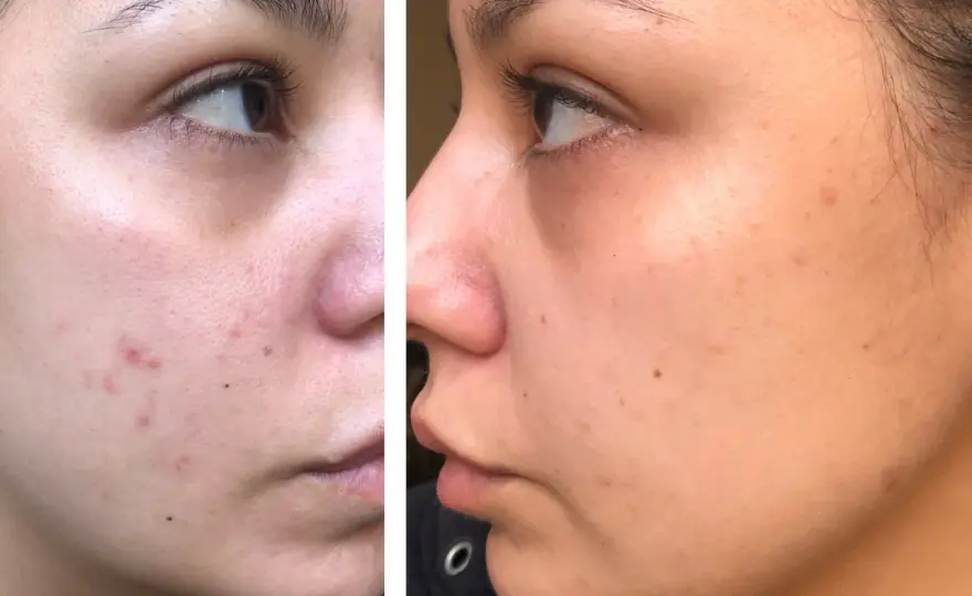 Dermapen: Få slätare hud – Pris, resultat & vad du bör veta
