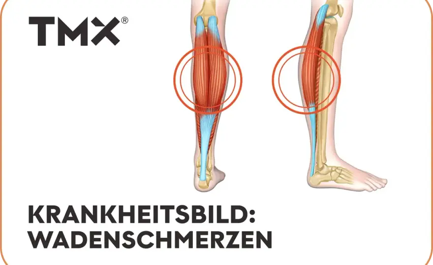Wadenschmerzen - was dahintersteckt und wann es ernst wird