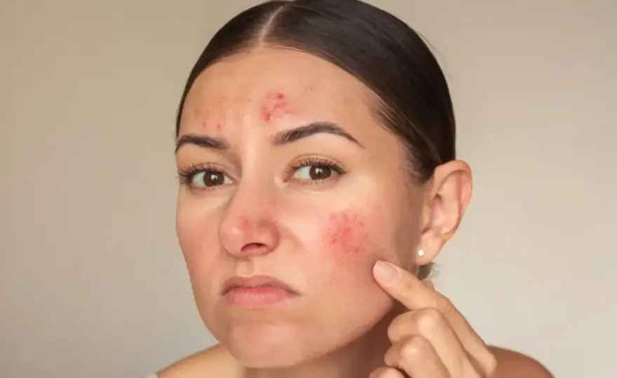 AZS za uszami? Rozpoznaj i lecz - Poradnik dermatologa