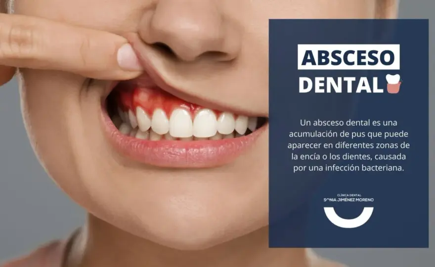 Absceso en la encía - qué hacer y cuándo es urgente