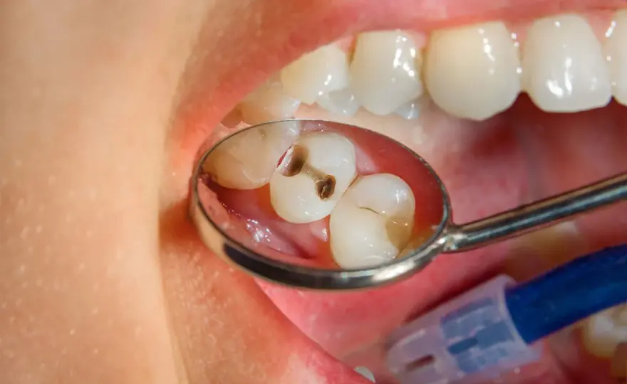 Dente bucato o carie? Come riconoscerla e cosa fare