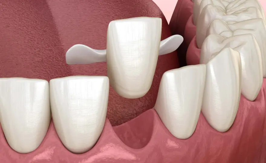 Ponte Maryland allentato - Reincollare o rifare? La guida