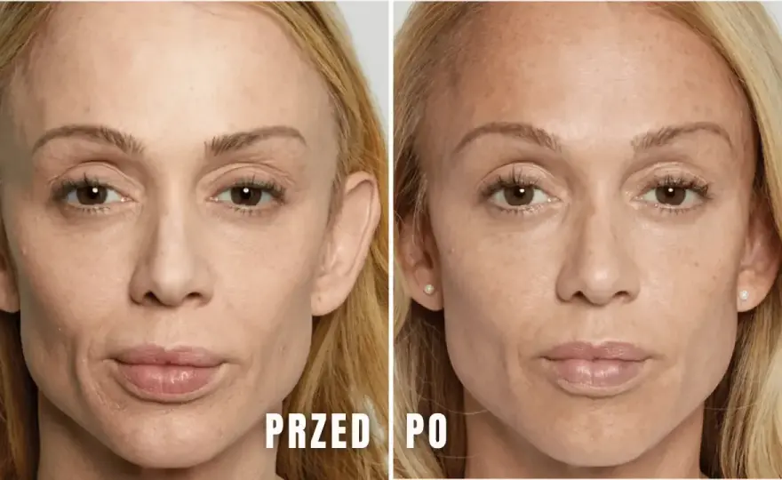 Ile kwasu hialuronowego dziennie? Sprawdź, aby uniknąć błędów