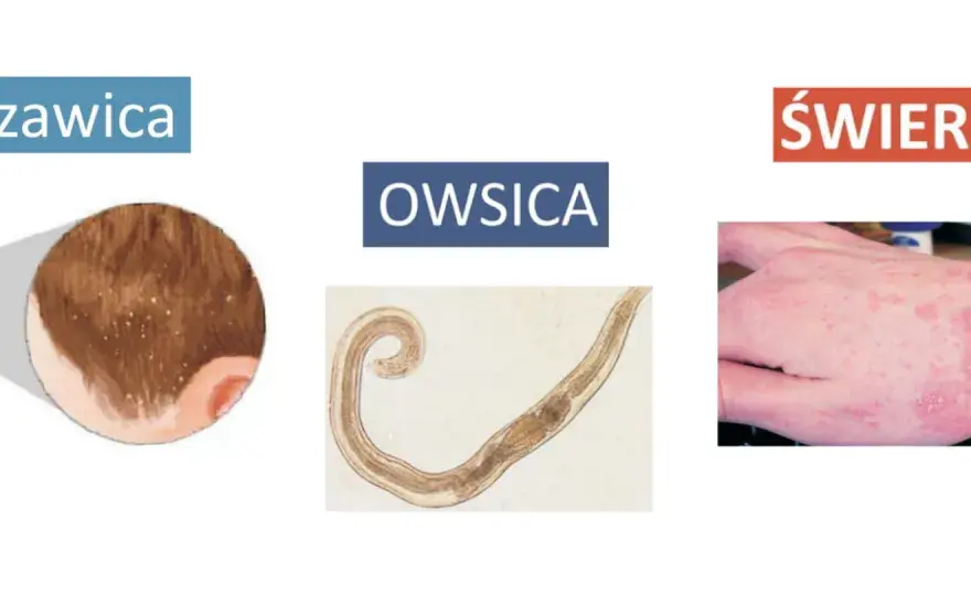 Najczęstsze objawy owsicy: poznaj 6 niepokojących sygnałów choroby