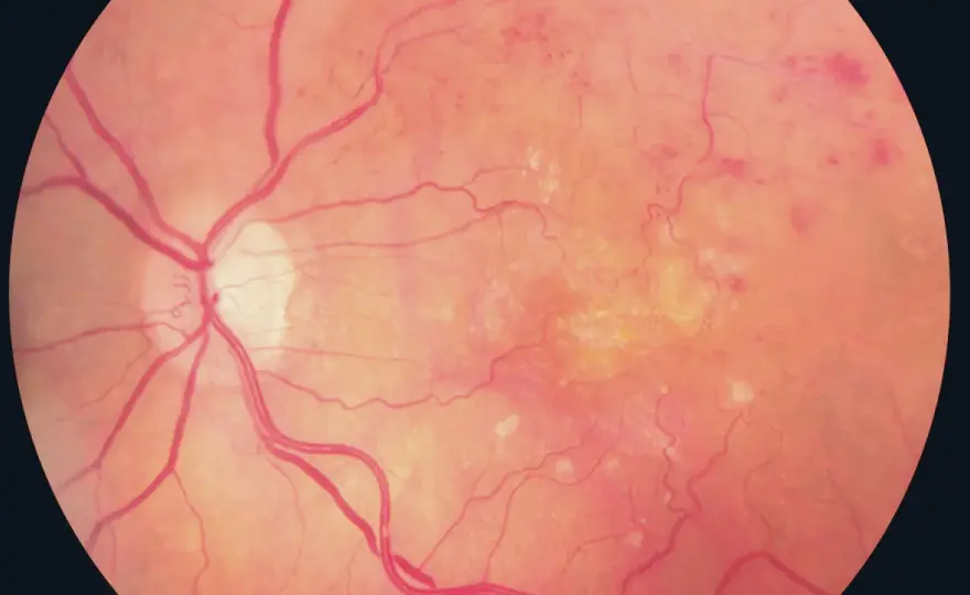 Retinopatia cukrzycowa - kiedy reagować, by chronić wzrok?
