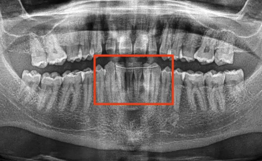 Dente mobile - Si può salvare? Cause e cosa fare subito