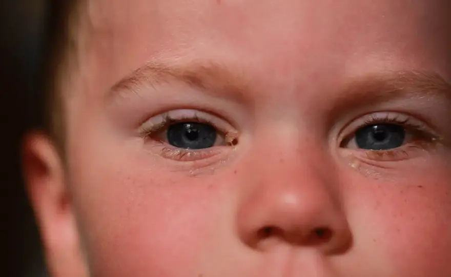 Conjuntivitis infantil - ¿Qué colirio usar y cuándo consultar?
