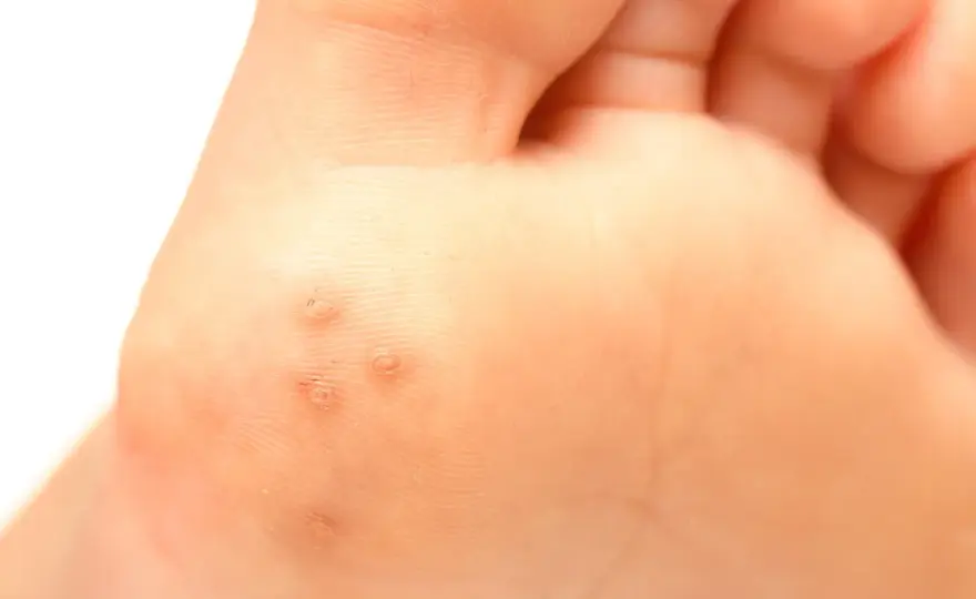 Vårta med svarta prickar – Vad betyder de & när söka vård?