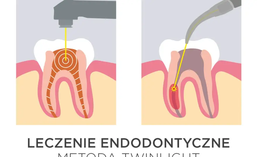 Leczenie zębów laserem - czy warto? Fakty, ceny i korzyści