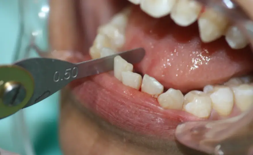 ¿Limar los dientes con Invisalign debilita el esmalte?