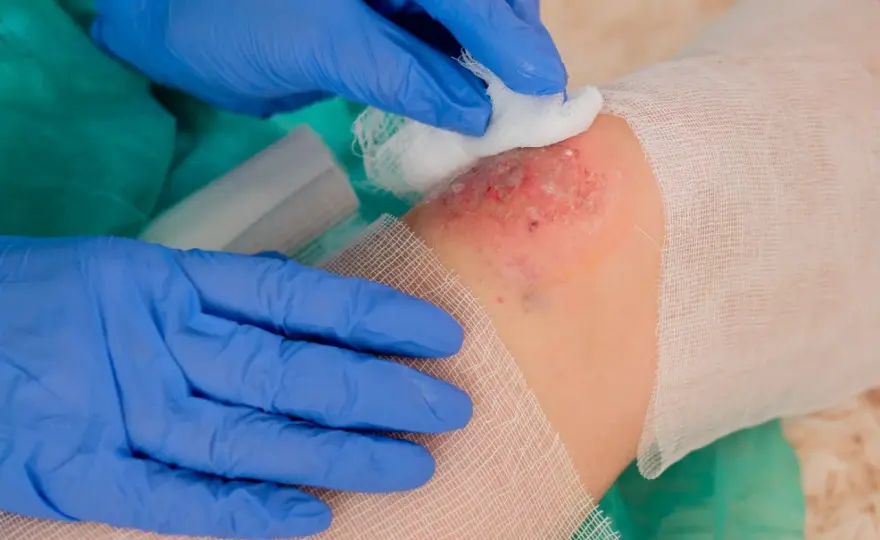 Biofilm w ranie - Kiedy gojenie nie idzie? Sprawdź!
