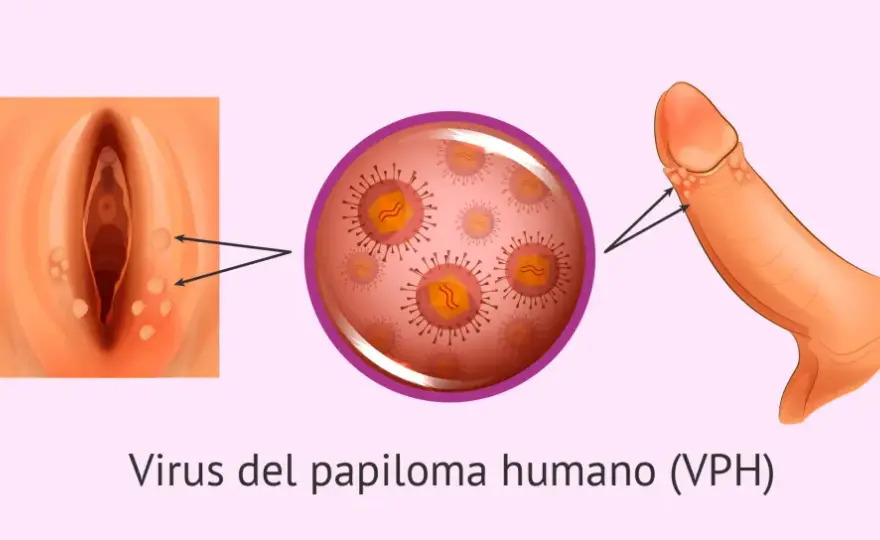 Síntomas del papiloma humano en mujeres: lo que debes saber para actuar