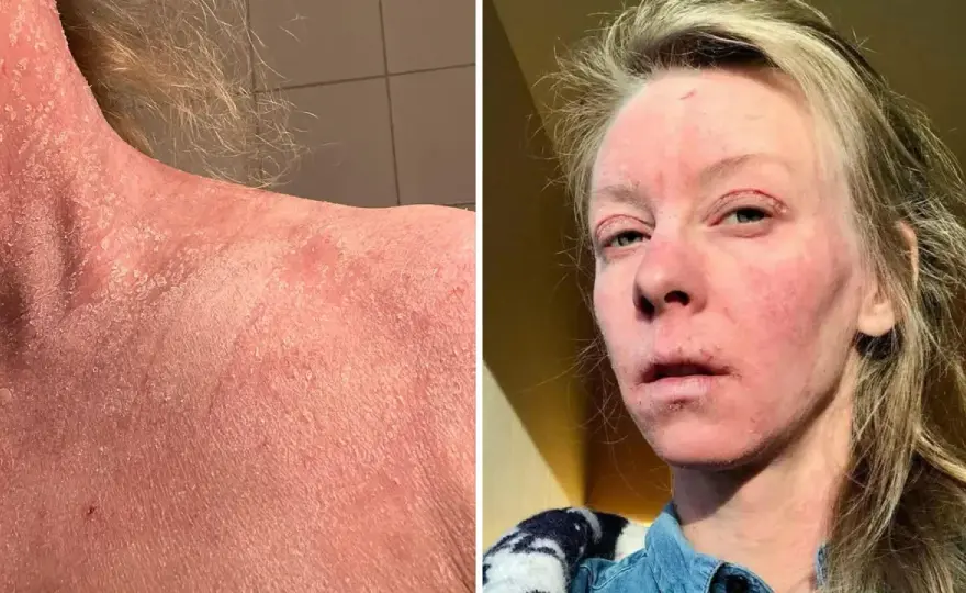Thiamidol biverkningar - Så undviker du irritation i huden