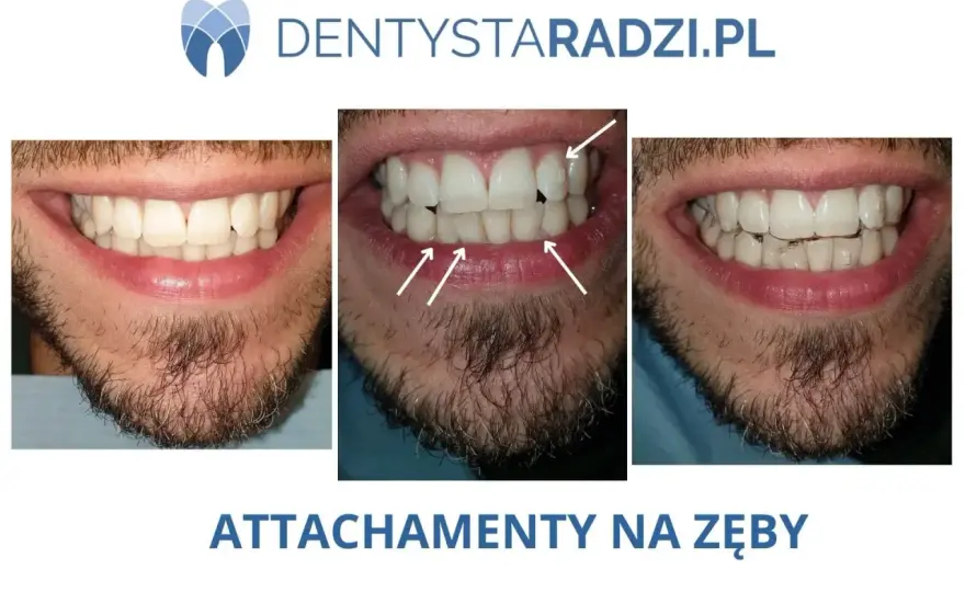 Nakładki na zęby - Czy działają? Prawda o leczeniu i kosztach