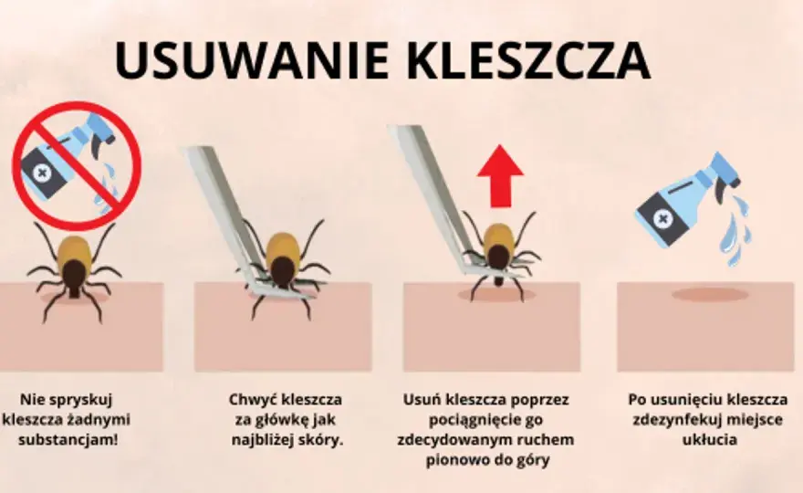 Nimfa kleszcza: jak usunąć bezpiecznie? Instrukcja krok po kroku