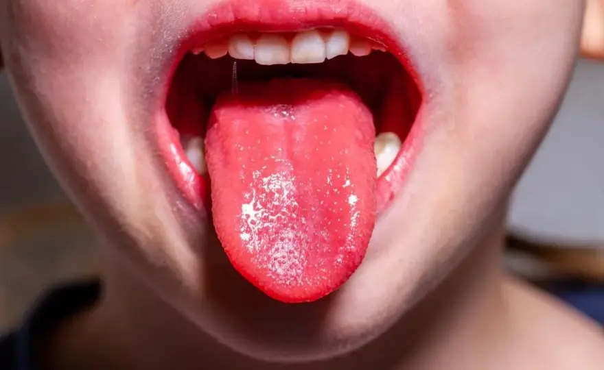 Lingua bianca bambino: streptococco o no? La guida per i genitori
