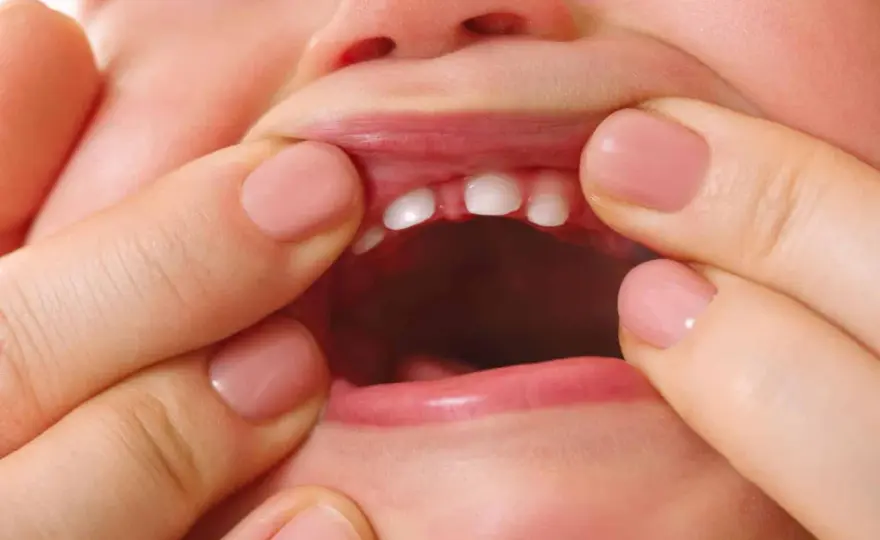 Frenillo labial inferior inflamado - causas y cuándo preocuparse