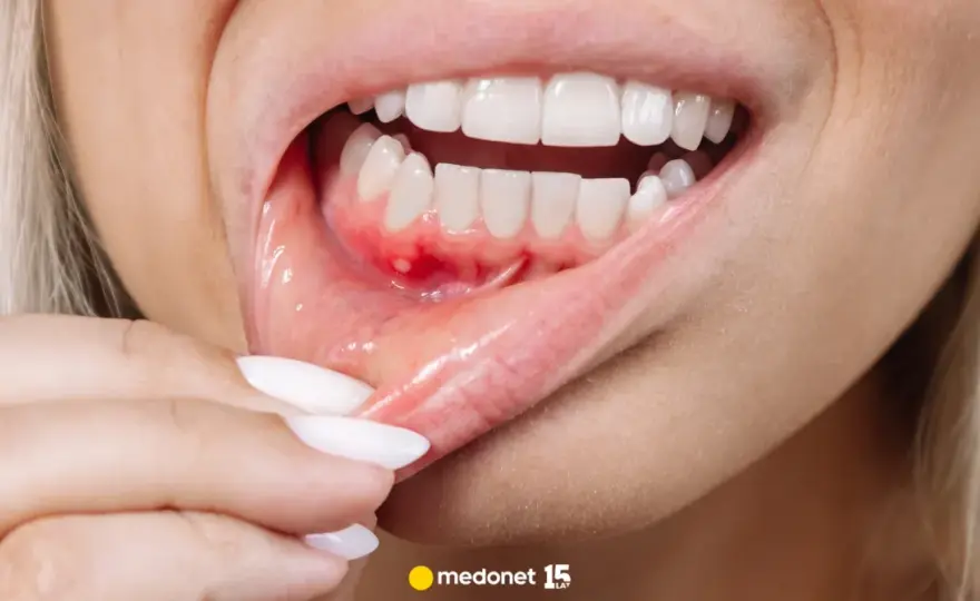 Ból dziąsła: Szybkie domowe sposoby, leki i kiedy iść do dentysty
