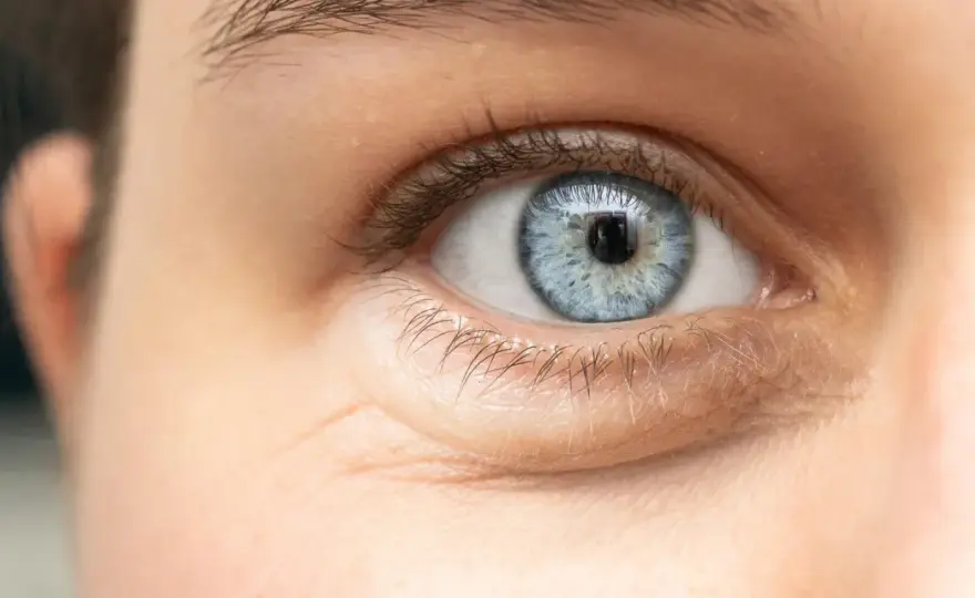 Ojeras hinchadas - causas y qué hacer para reducirlas