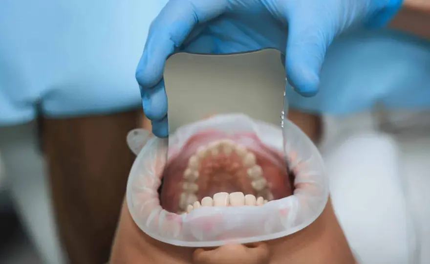 Caries leve - ¿se puede evitar el empaste?