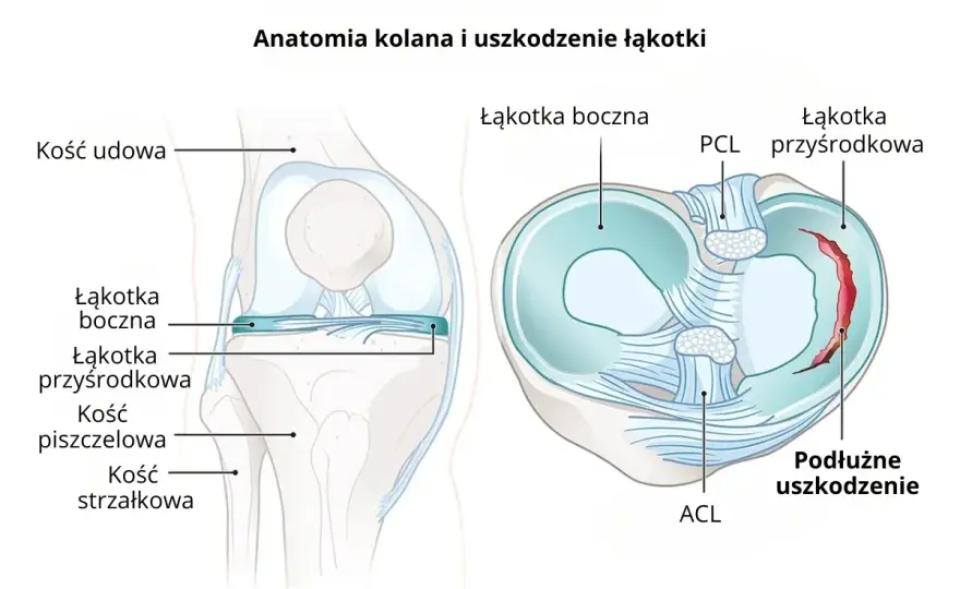 Menisk w kolanie - Czy to uszkodzenie? Objawy, leczenie, rehabilitacja
