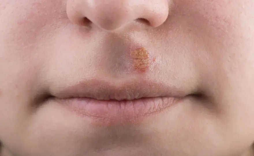 Herpes sul mento? Sintomi, rimedi e quando farsi vedere