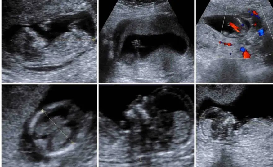 Singhiozzo fetale - quando è normale e quando preoccuparsi