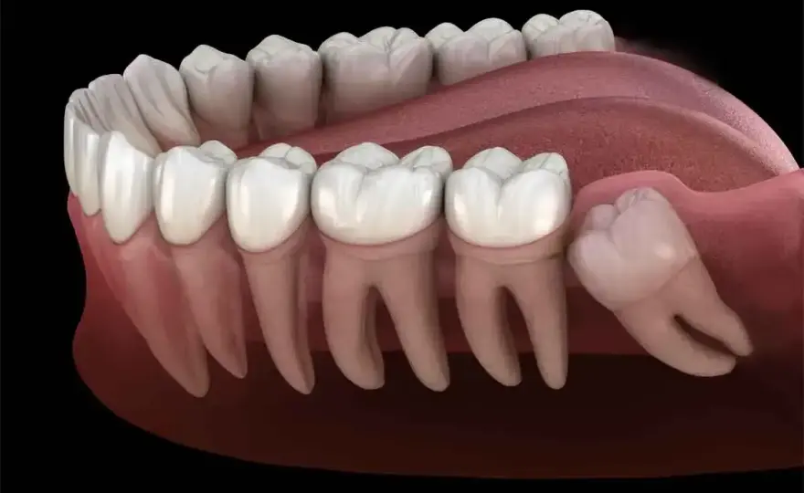 Zapalenie ósemki - Objawy, leczenie, kiedy do dentysty?