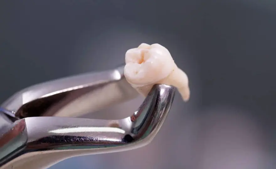 Exodoncia dental - cuándo se necesita y cómo cuidarse