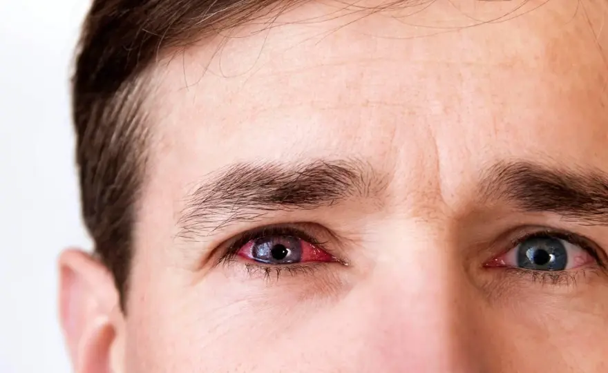 Conjonctivite, symptômes et bons réflexes pour protéger vos yeux