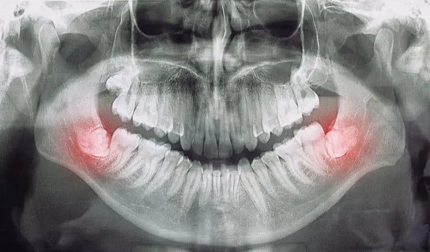 Gdzie z bólem zęba Chełm? Znajdź natychmiastową pomoc dentystyczną