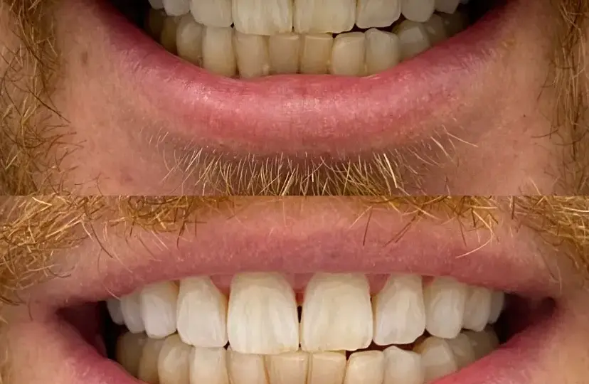 Wybielanie zębów u dentysty: efekty, koszty czy warto?