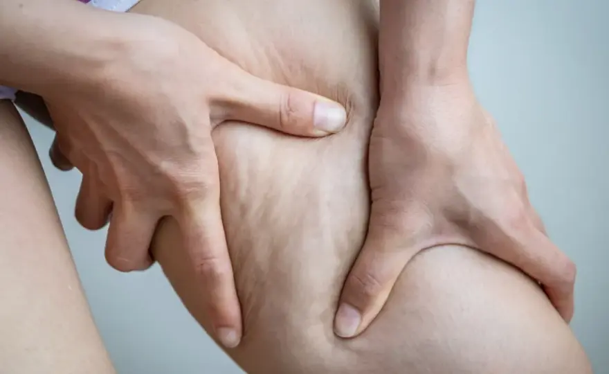 Jak pozbyć się cellulitu z ud? Domowe sposoby i zabiegi