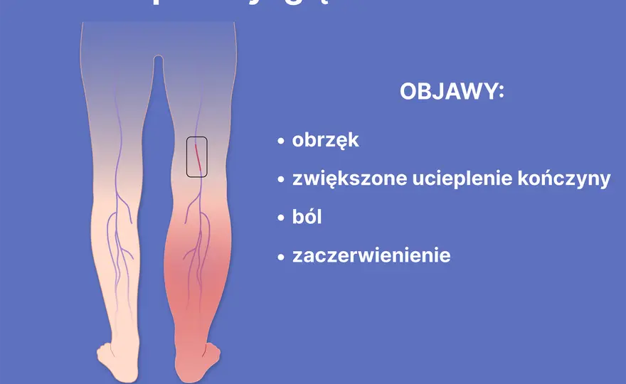 Objawy zaburzeń krzepnięcia krwi: Krwotok czy zakrzep? Sprawdź!