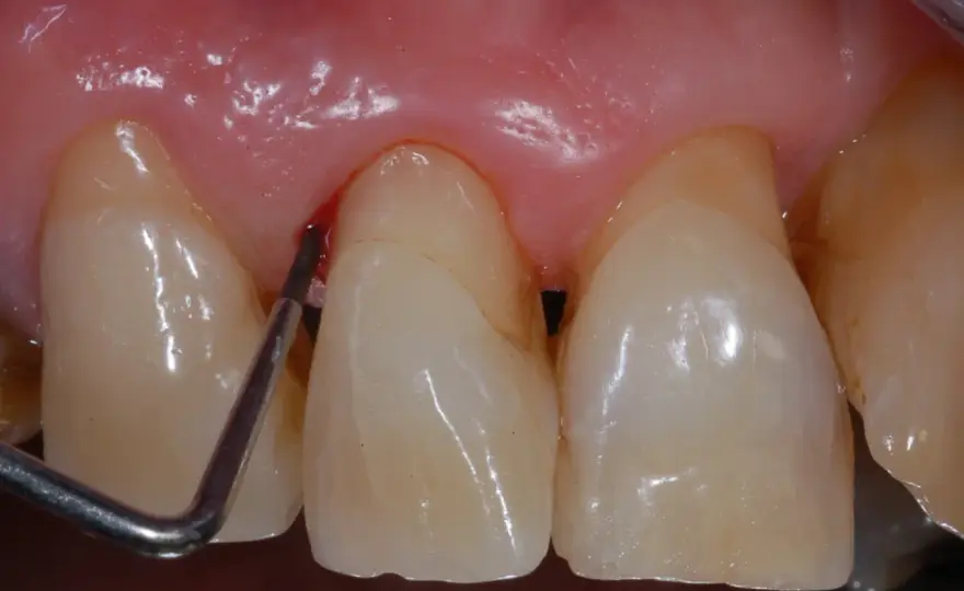 Gengive che sanguinano - cosa fare e quando dal dentista