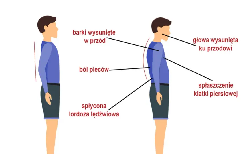 Ból pleców - czy to ZZSK? Objawy zesztywniającego zapalenia stawów