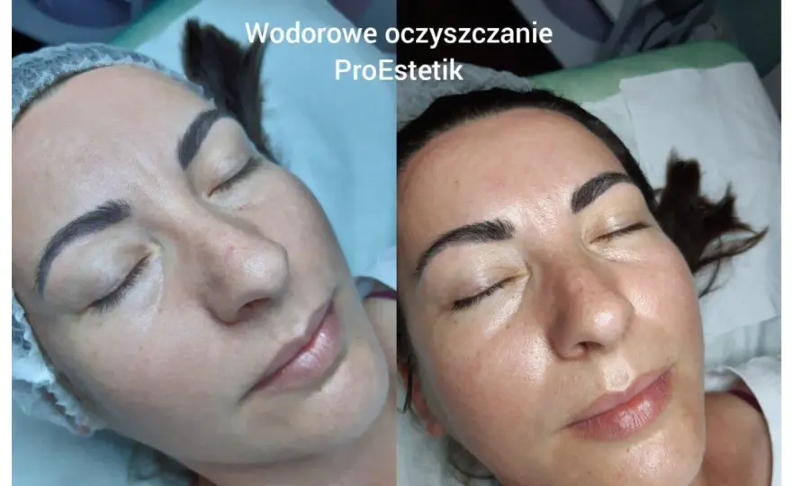 Oczyszczanie wodorowe twarzy - Czy warto? Poznaj realne efekty i ceny