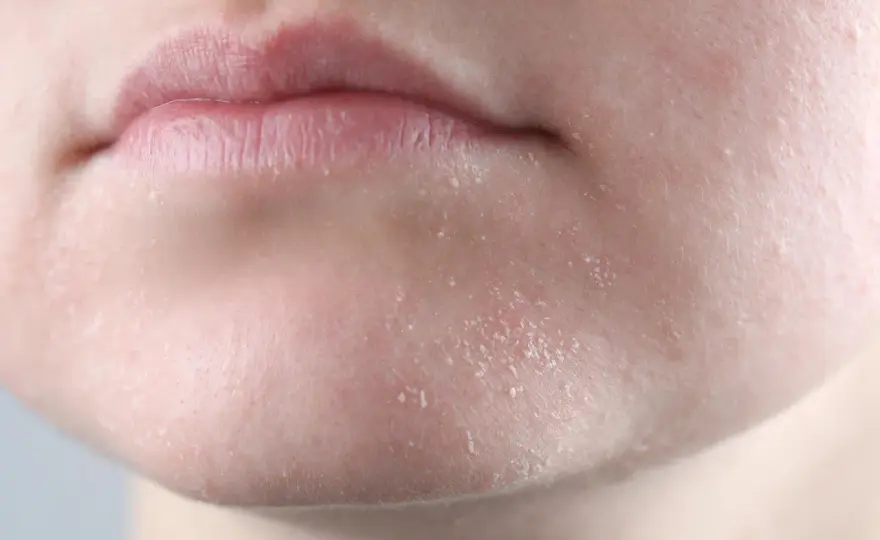 Peau sèche du visage - causes et routine pour la soulager