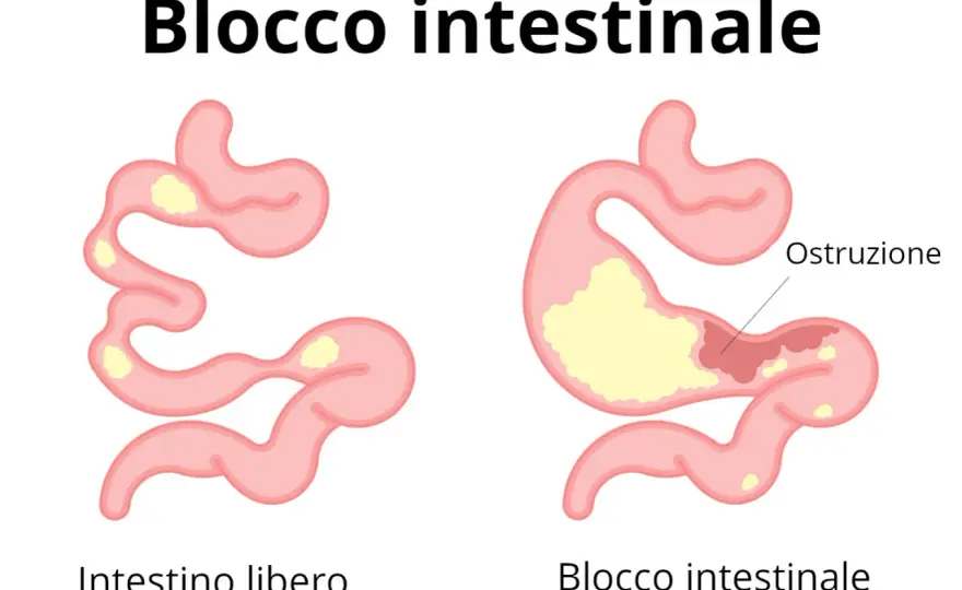 Stitichezza e blocco intestinale - cosa fare e quando preoccuparsi