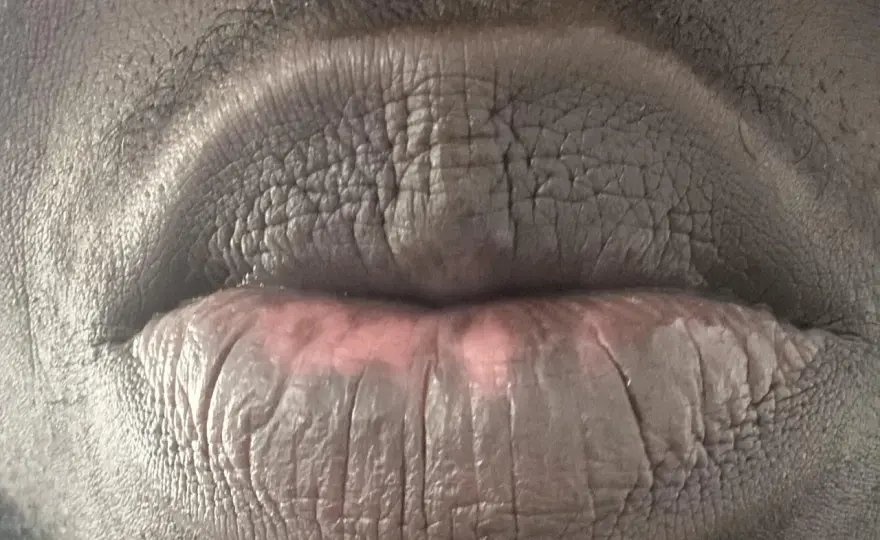 Manchas en los labios por fumar - causas y señales de alerta