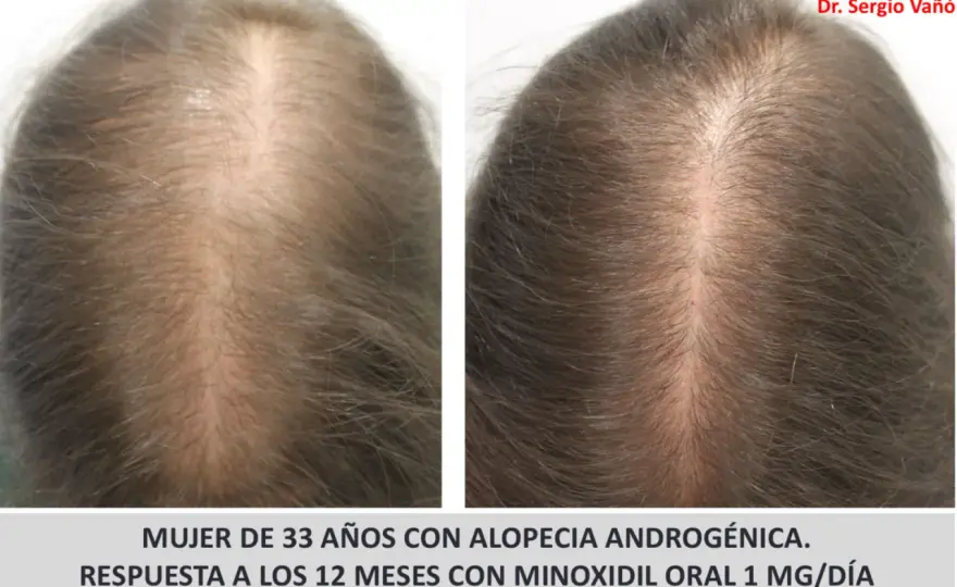 Minoxidil en mujeres - cuándo funciona y cómo usarlo bien