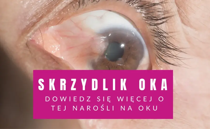 Skrzydlik oka - czy zawsze trzeba operować? Pełny poradnik