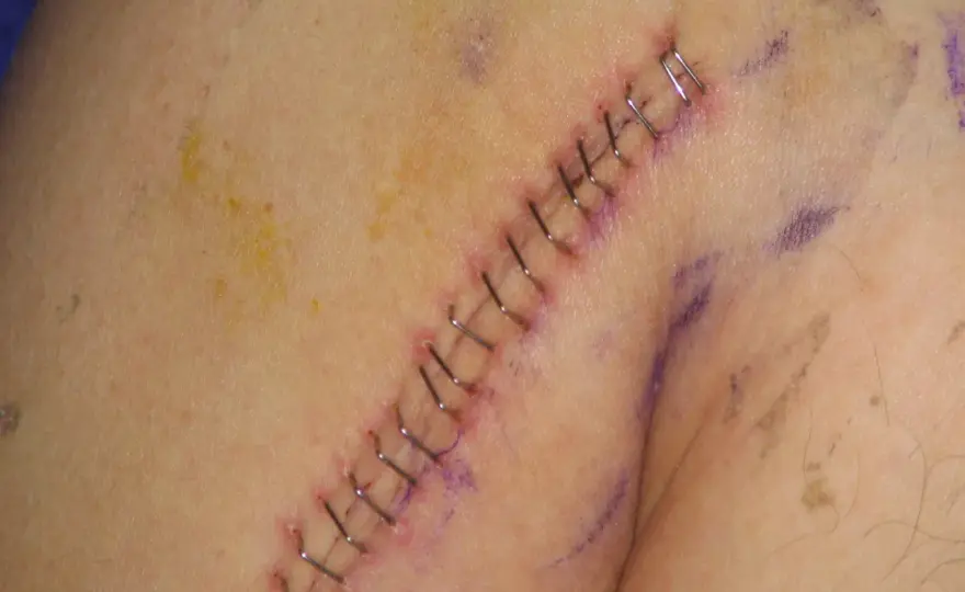Point de suture qui saute, que faire ?