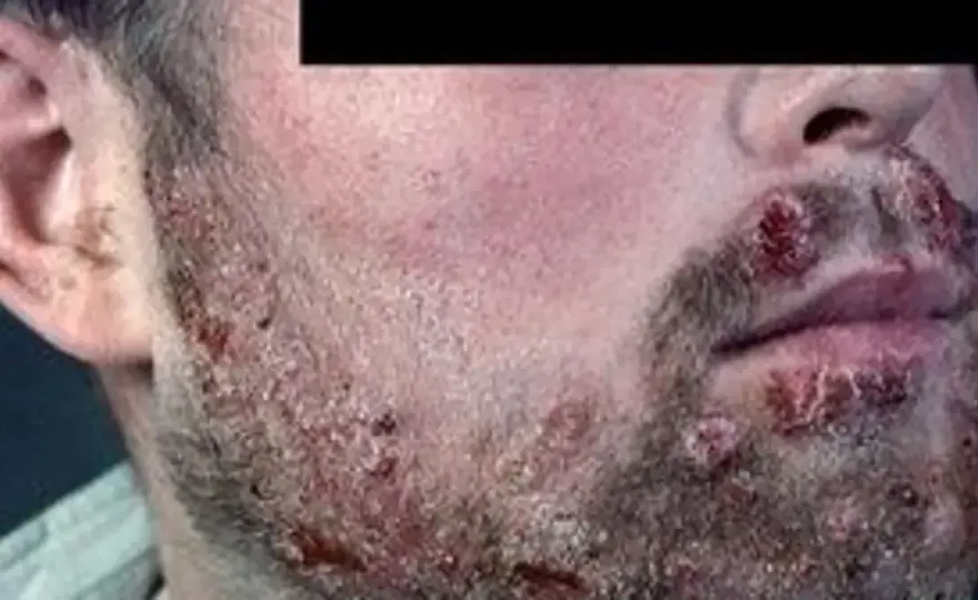 Grzybica brody - objawy, leczenie i kiedy do dermatologa