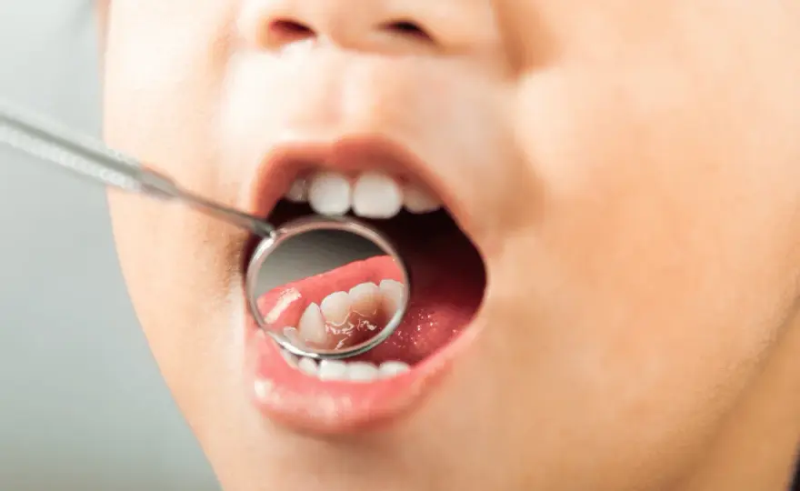 Denti da latte cariati - segnali, cure e prevenzione