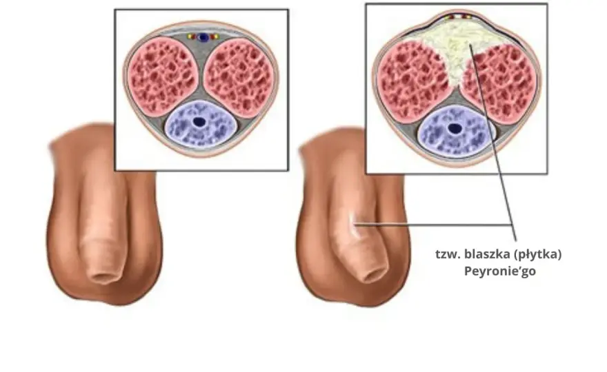 Choroba Peyroniego - skrzywienie prącia. Kiedy leczyć?