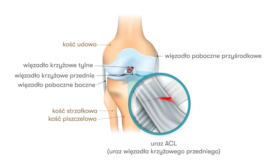 Więzadło krzyżowe przednie - leczenie, objawy, powrót do sportu